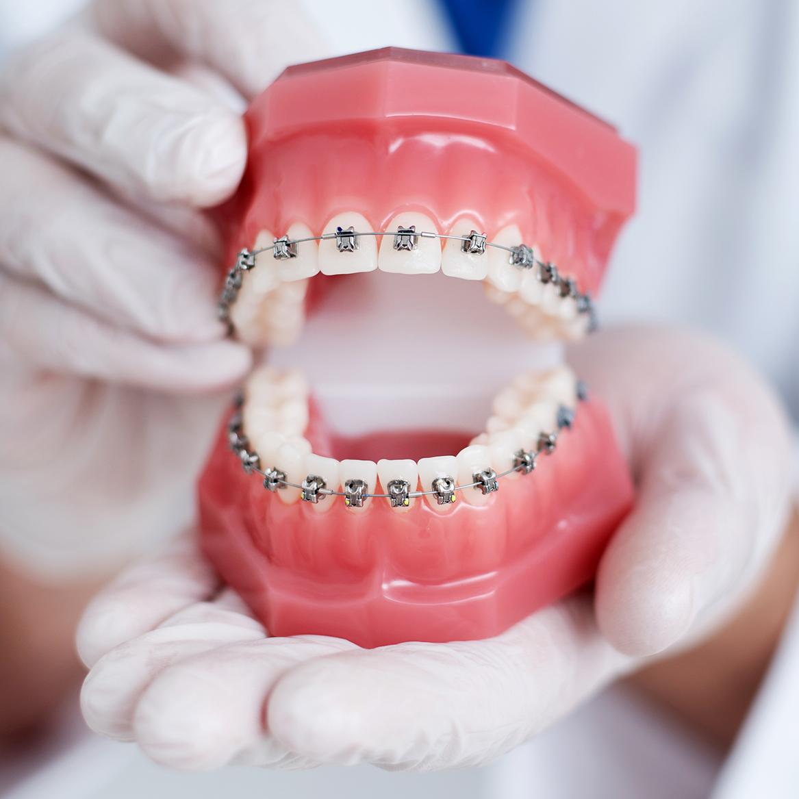 Thời gian niềng răng trung bình từ 12 – 24 tháng
