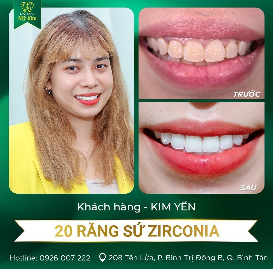 20 Răng sứ Zirconia - Chị Kim Yến