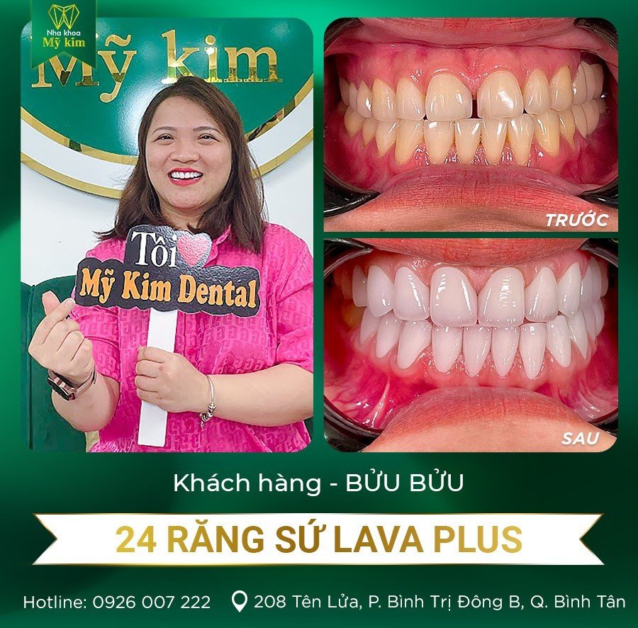 Hình ảnh khách hàng thực tế sử dụng dịch vụ bọc răng sứ ảnh 2