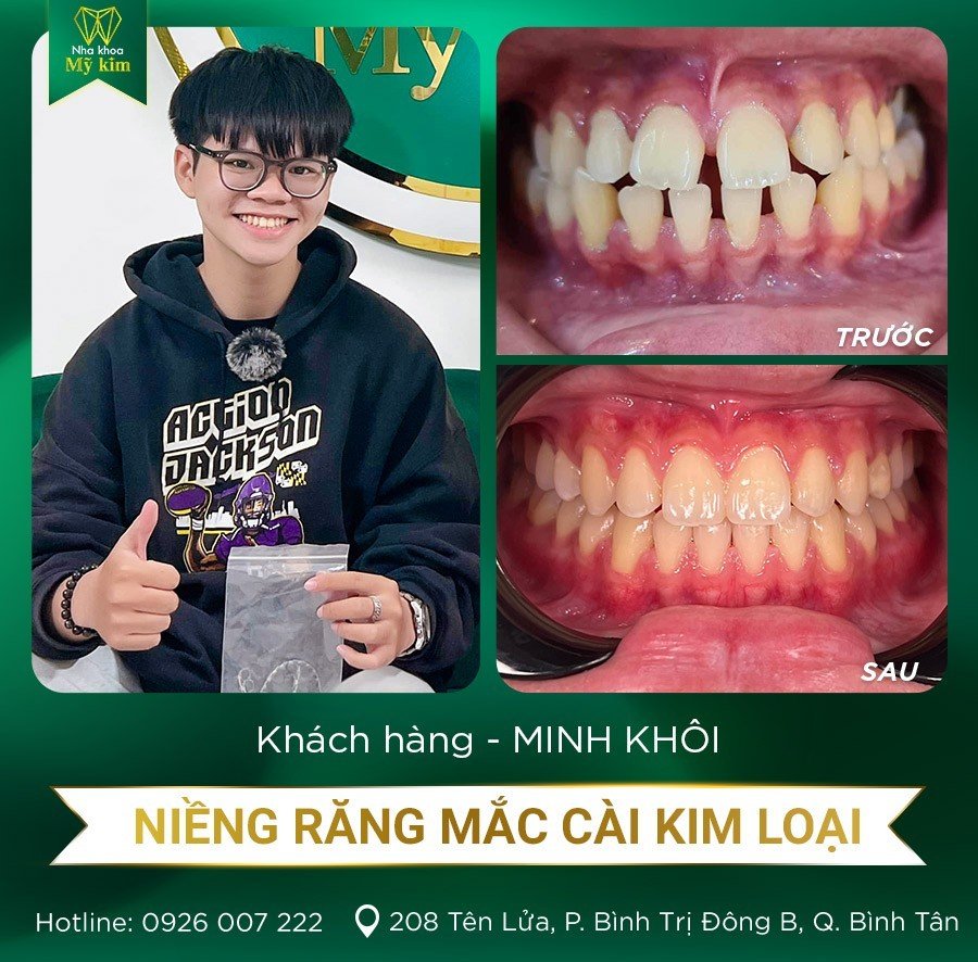 Niềng răng mắc cài kim loại - Anh Minh Khôi