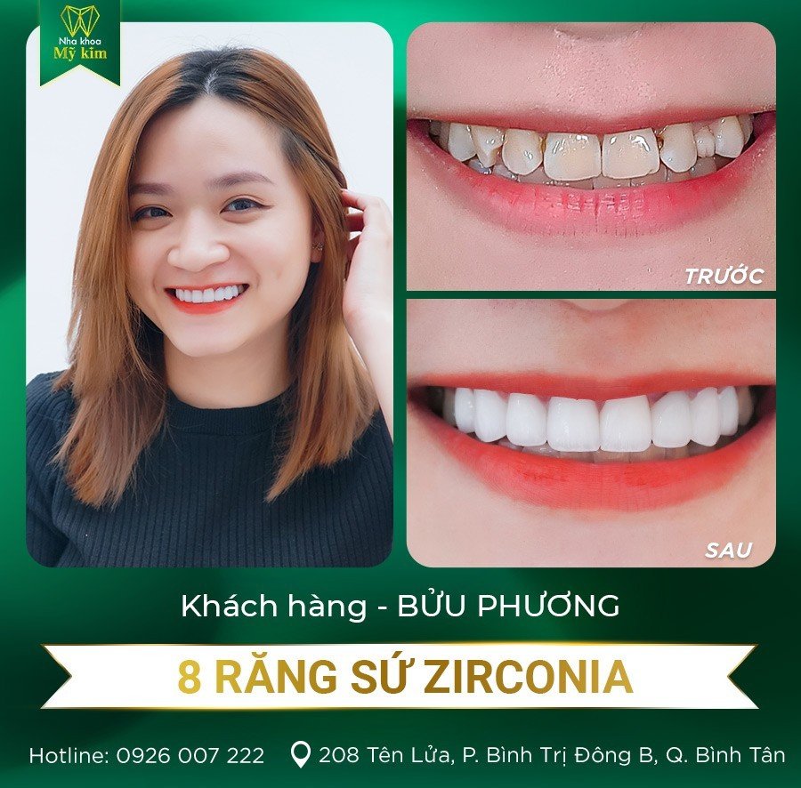 8 Răng sứ Zirconia - Chị Bửu Phương