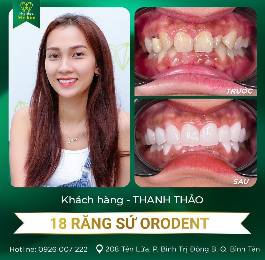 Răng sứ Orodent - Chị Thanh Thảo