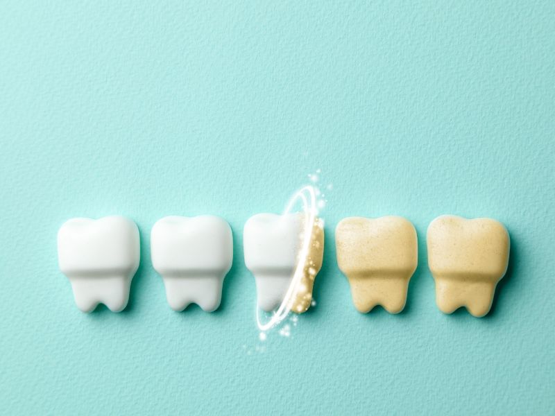 Tẩy trắng răng là gì? Chi phí tẩy trắng răng bao nhiêu?