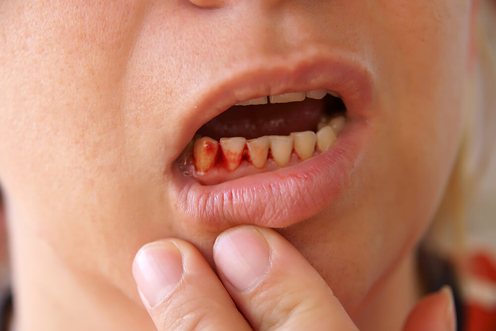 Tại sao chảy máu chân răng? Cách xử lý hiệu quả