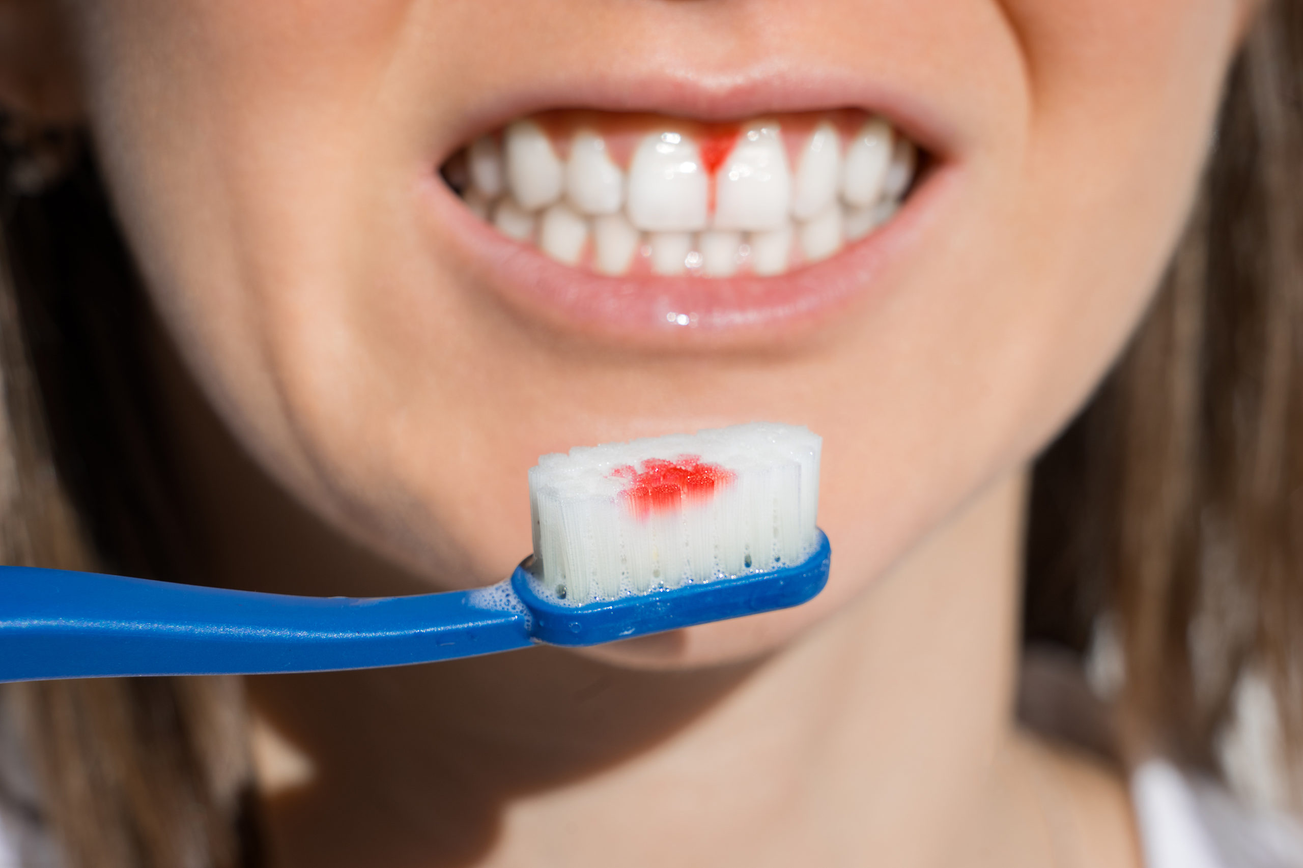 Đánh răng mạnh cũng khiến bị chảy máu chân răng