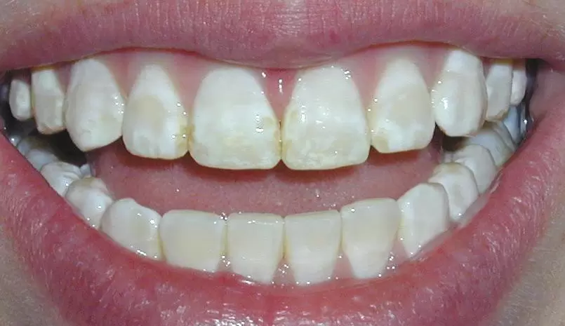 Những dấu hiệu mòn men răng và cách xử lý