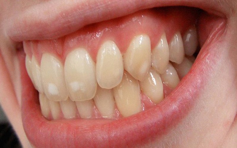 Răng bị nhiễm tetracycline