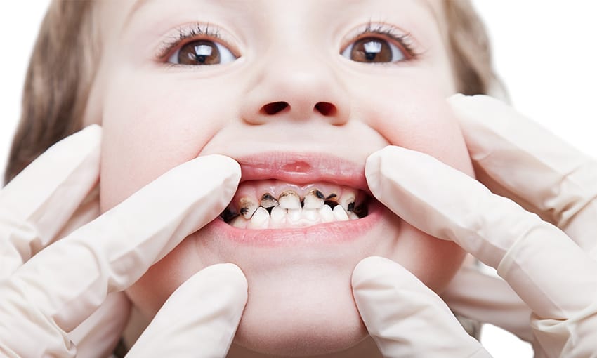 Nguyên nhân chính gây ra sâu răng là do vi khuẩn trong miệng, đặc biệt là loại Streptococcus mutans