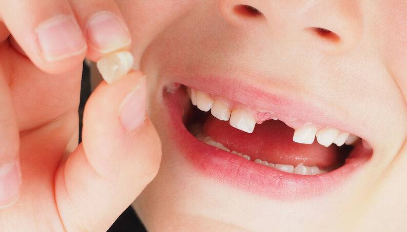 Quá trình thay răng sữa là quá trình phát triển bình thường của trẻ em