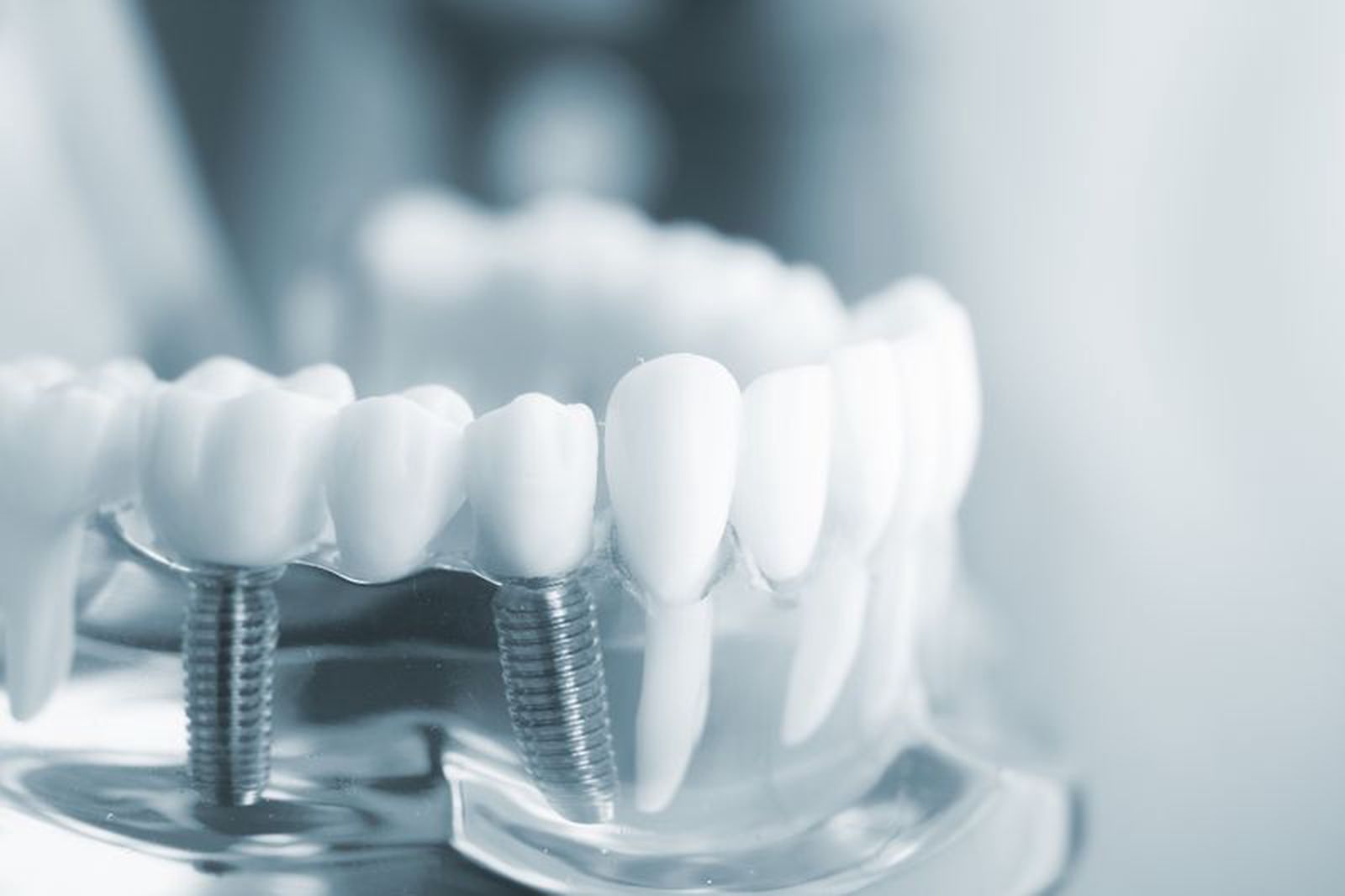 Tìm hiểu về phương pháp trồng răng Implant an toàn và thẩm mỹ